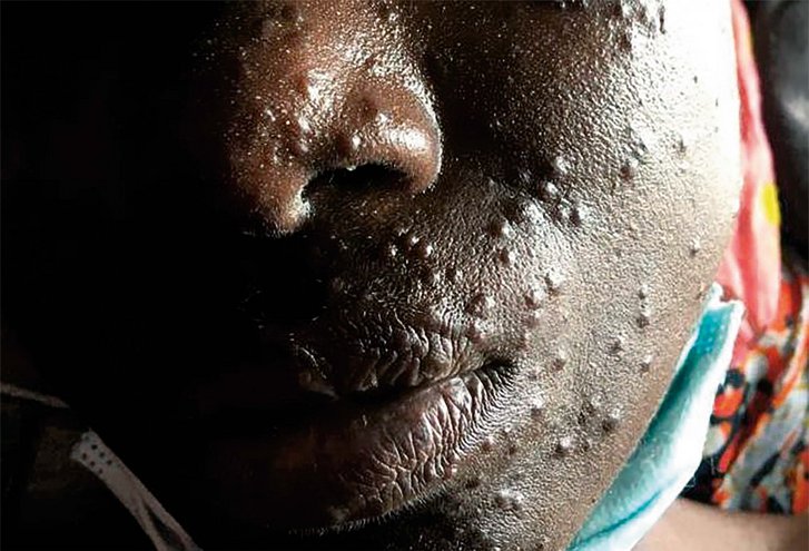 Tansanische Patientin mit Knötchen an der Haut. Ein Hautarzt kann mit diesem Bild dem Arzt vor Ort bei der Diagnose und Therapie zur Seite stehen. (Foto: Romina Nemecek)